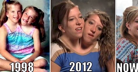 20 Interesting Things About Famous Conjoined Twins Abby And Brittany