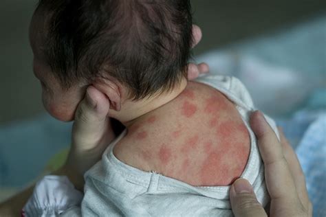 Qué causa las erupciones en los bebés y cómo prevenirlos