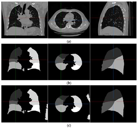 Sensors Free Full Text A Fissure Aided Registration Approach For Automatic Pulmonary Lobe