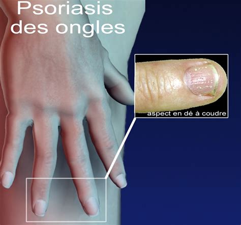 Dermato Info Le Psoriasis