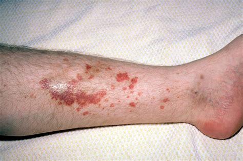 Breaking Out In A Rash Could Be A Sign Of Cancer Here S How Tell If