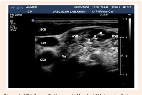 Figure From Ultrasound Guided Interscalene Nerve Block An