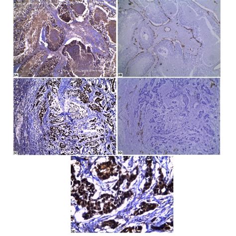 Microvessel Density MVD In Relation To Maspin Expression And