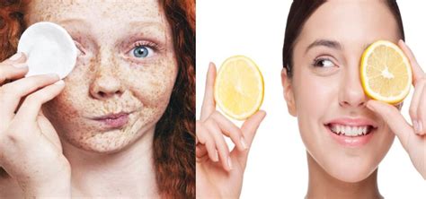 Cómo Quitar Las Pecas ¿sirven Los Remedios Naturales