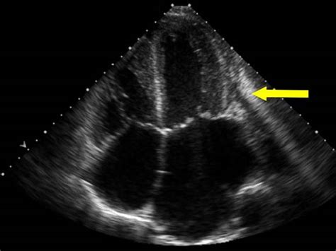 Common Ultrasound Artefacts Rcemlearning India