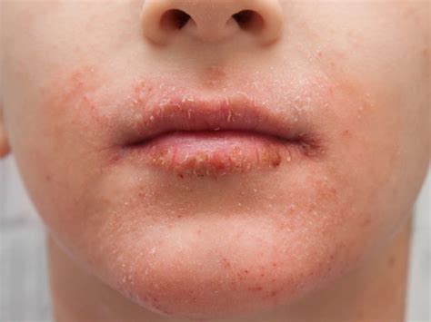 Allergy Rash Mouth Continental Clinic