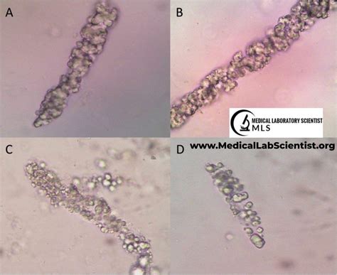 Wbc Casts In Urine