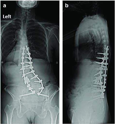 Anteroposterior A And Lateral B Standing Radiographs At 2 Years