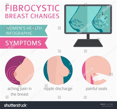 Fibrocystic Breast Changes Disease Medical Infographic Stock Vector