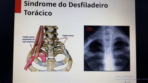 Aula Síndrome do Desfiladeiro Torácico YouTube