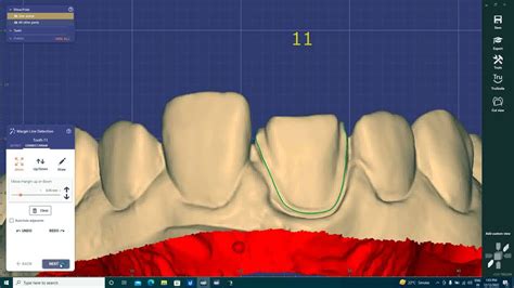 Cad Camcadcam Making Of Dental Veneers Laboratoryemax Youtube