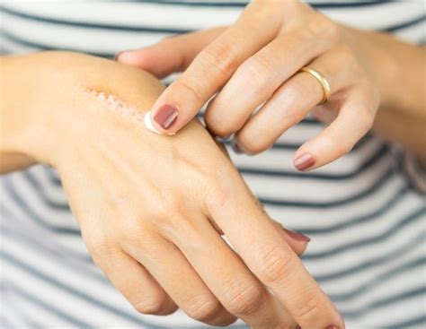 Tratar Y Curar Una Quemadura De Aceite De Cocina En La Piel Bekia Belleza