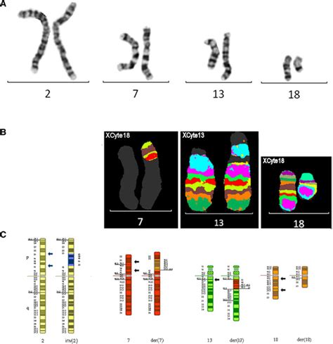 Chromosomes 2 7 13 And 18 For Case 4 G Banded Chromosomes 2 7 13 Download Scientific