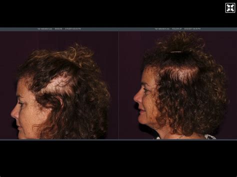 Prp Hair Restoration Before And After Pictures Halo