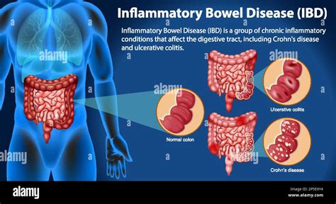 Inflammatory Bowel Disease Ibd Infographic Illustration Stock Vector