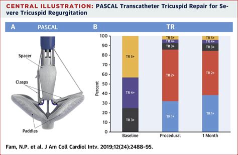 Compassionate Use Of The Pascal Transcatheter Valve Repair System For