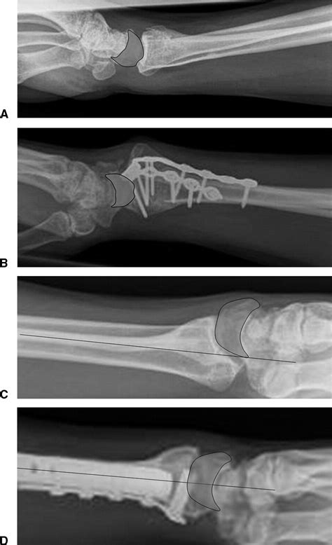 Evaluation Of Corrective Osteotomy Of The Malunited Distal Radius On