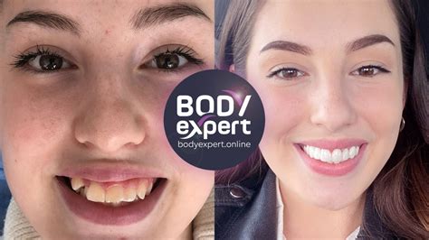 Couronnes dentaire Avant Après résultats après la pose Body Expert