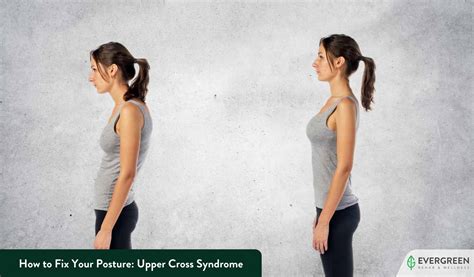 Effective Upper Cross Syndrome Stretches For Improved Posture Learn All About Yoga