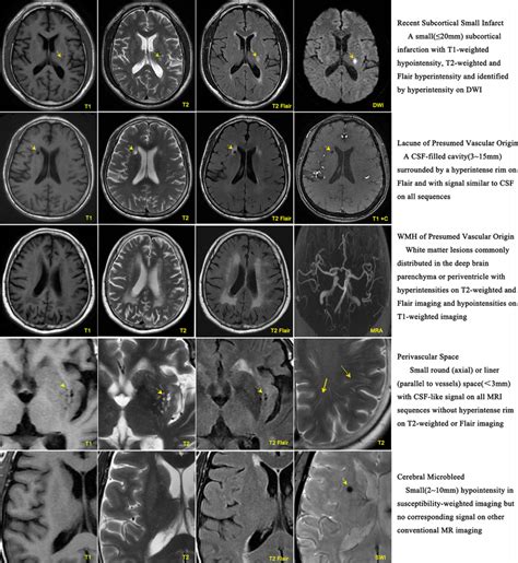 Neuroimaging Characteristics Of Cerebral Small Vessel Diseases In MRI