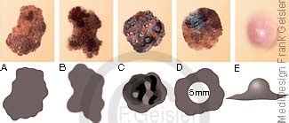 Hautkrebs Abcde Test Der Haut