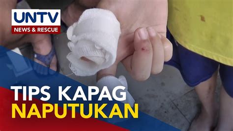 Biktima Ng Paputok Umabot Na Sa 32 Mga Dapat Gawin Kapag Naputukan