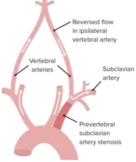 Subclavian Artery Vertebral Artery