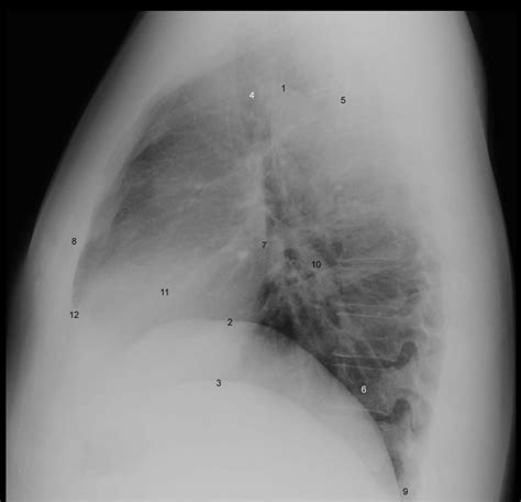 Lateral Chest Radiograph Diagram Quizlet