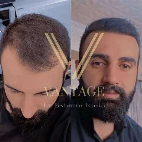 3000 Grafts Hair Transplant Turkey Costs 2024 Vantage Turkey