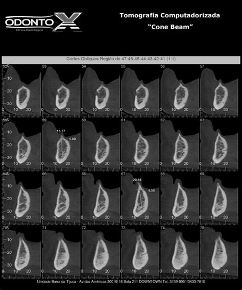 Tomografia Computadorizada Cone Beam OdontoX Clínica Radiológica