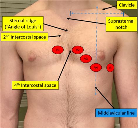 Proper Electrocardiogram Ecg Ekg Lead Placement Ecgedu