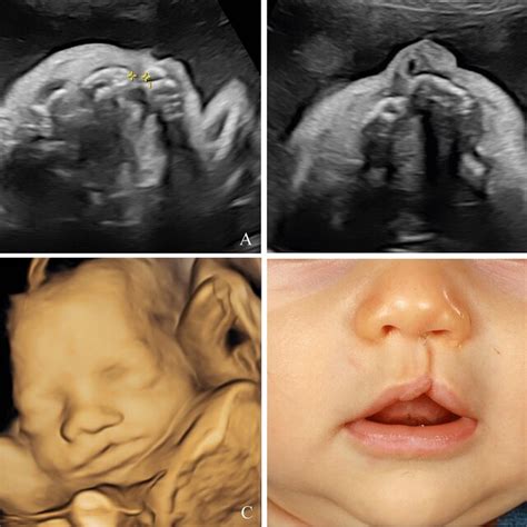 Unilateral Cleft Lip And Palate Visualized On Ultrasound During The Download Scientific