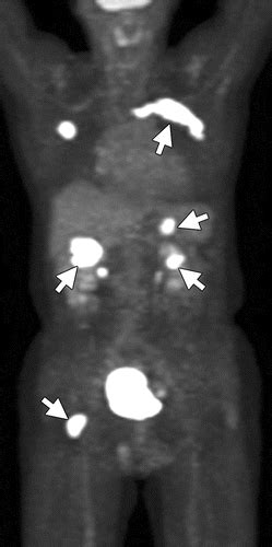 Mr Imaging And Petct In Diagnosis And Management Of Multiple Myeloma