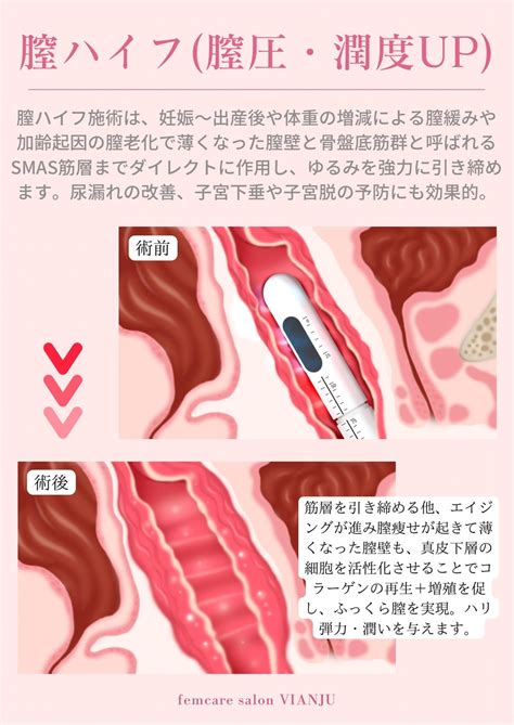 【vianju】症例モニター様募集概要｜膣ハイフand大陰唇タイトニング 【vianju 東京・麻布 フェムケアサロン・ヴィアンジュ