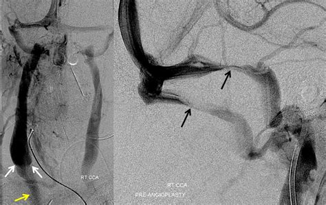 Case Archives Venous Pulsatile Tinnitus