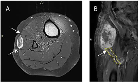 Cancers Free Full Text The Prognostic Relevance Of Mri