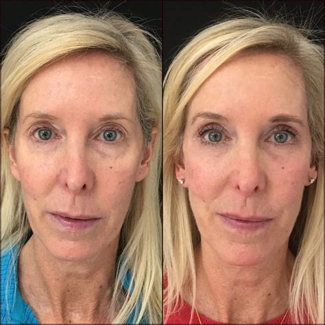 Top 95 Pictures Lower Blepharoplasty Recovery Photos Day By Day Updated