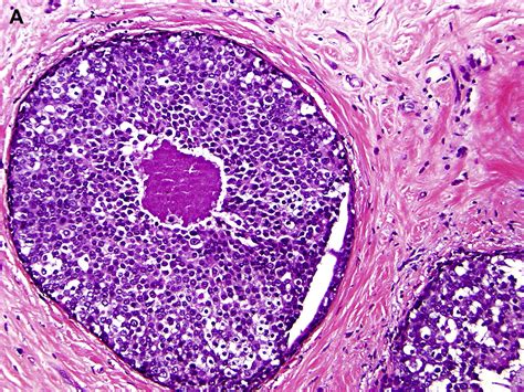 Lobular Carcinoma In Situ Classical Type And Unusual Variants