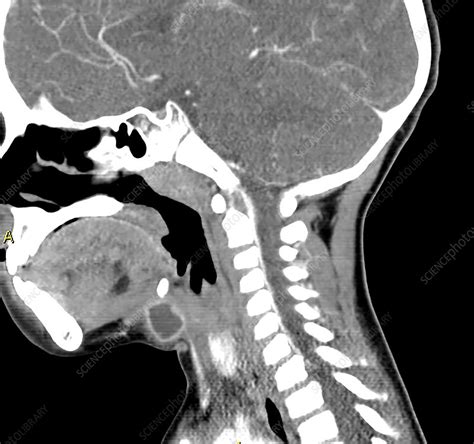 Infected Thyroglossal Duct Cyst Ct Scan Stock Image C030 6444