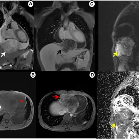 Cardiac Mri Shows Mass Tissue Characterization A Cine Imaging