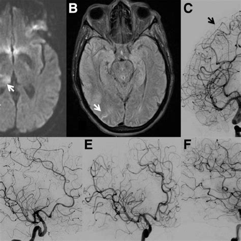 Illustrative Case Reversible Cerebral Vasoconstriction Syndrome Download Scientific Diagram