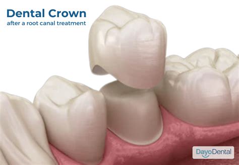 Root Canal Treatment Without A Crown How Long Will It Last