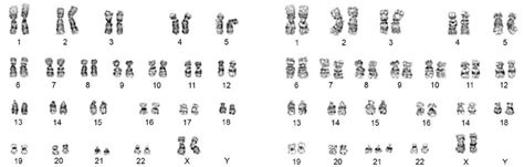 The G Banding Karyotypes Obtained From A Peripheral Blood That