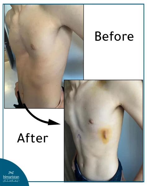 Pectus excavatum treatment in Turkey بيمارستان