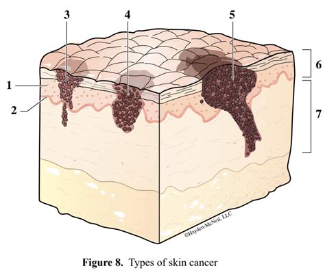 types of skin cancer Diagram | Quizlet