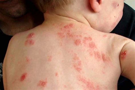 Eczema Dermatitis And How To Treat Dry Flaky And Itchy Skin Abc News