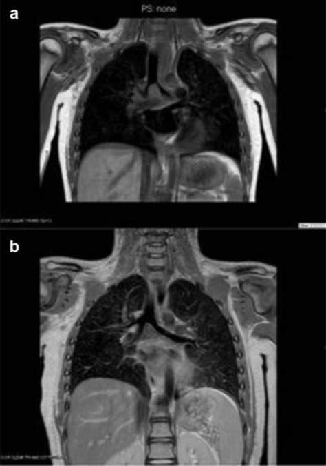 Mri Pre Operative A And 22 Months Post Operative B Download Scientific Diagram