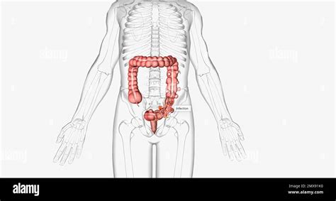 La Diverticulosis Ocurre Cuando Se Desarrollan Bolsas Pequeñas Y