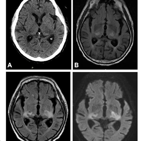 CT and MRI scans showing bilateral thalamic lesions. The CT scan of the... | Download Scientific ...