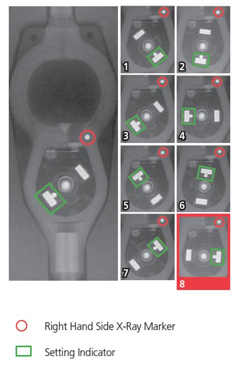 Determining Settings Of Programmable VP Shunts UW Emergency Radiology